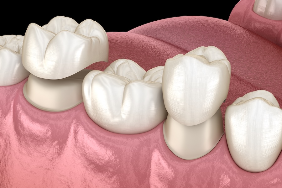 how to care for a tooth after a filling or dental crown